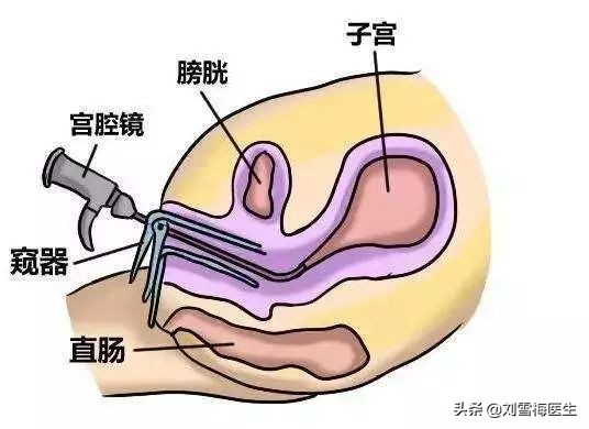 做试管需要做宫腔镜检查吗,宫腔镜检查需要家属陪同吗