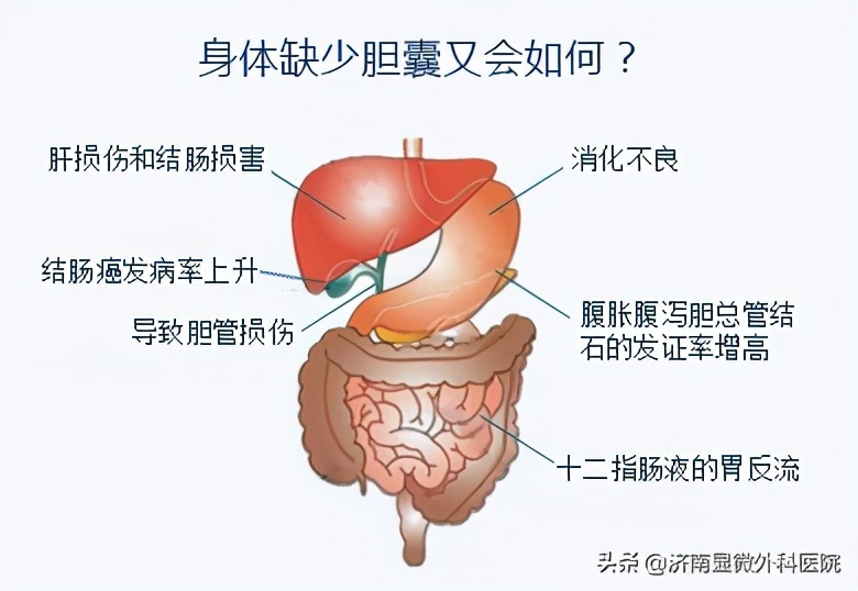 胆囊结石1.4厘米能保胆取石么,胆囊结石一厘米可以保胆取石吗