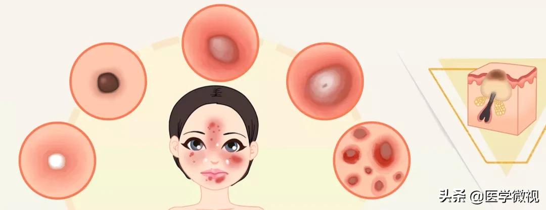 满脸痘痘怎么治不花钱,满脸痘痘中药调理效果如何