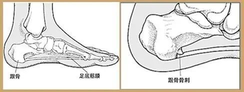 治疗足跟骨刺南阳,骨科康复医学科普骨刺