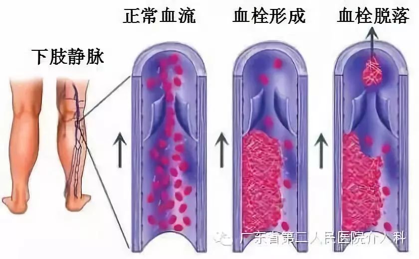 左腿血栓肿胀能完全恢复正常吗,左腿血栓肿痛怎么锻炼