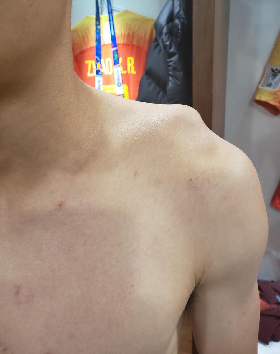 武磊的肩伤到底有多重,武磊肩伤