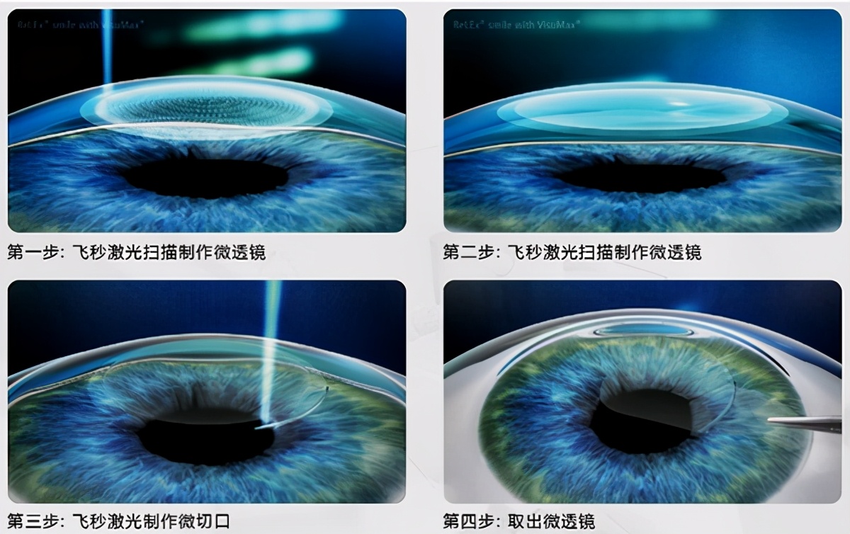 高考激光近视手术,高考参军近视眼要提前多久做手术