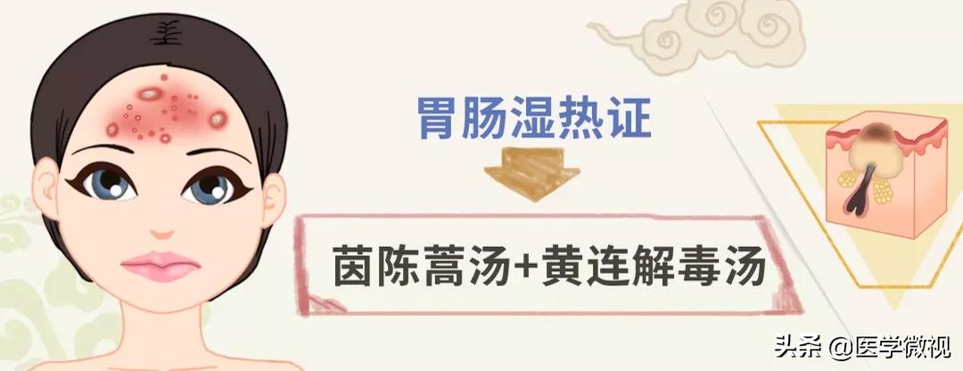 满脸痘痘怎么治不花钱,满脸痘痘中药调理效果如何
