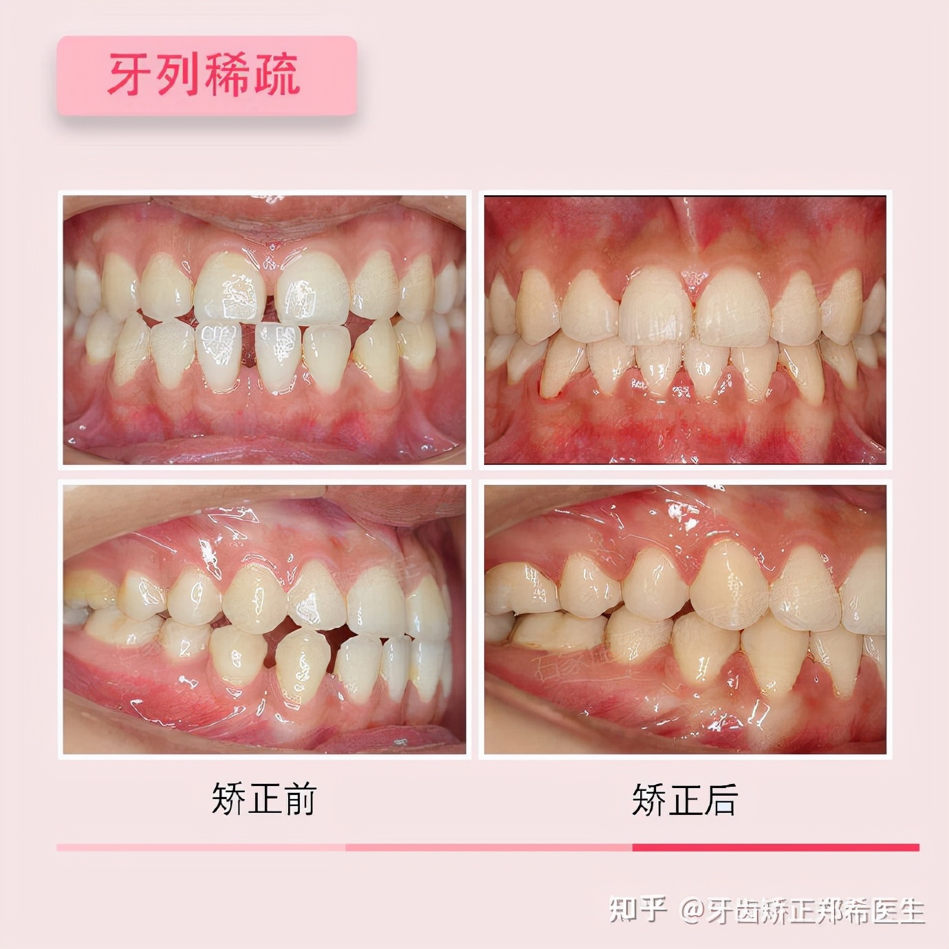 石家庄牙齿矫正视频,牙齿严重不齐矫正成功案例