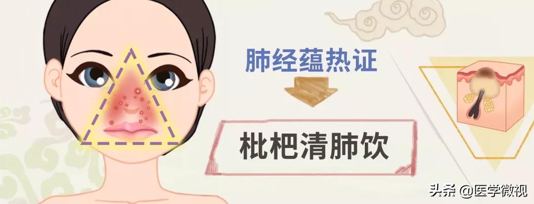 满脸痘痘怎么治不花钱,满脸痘痘中药调理效果如何