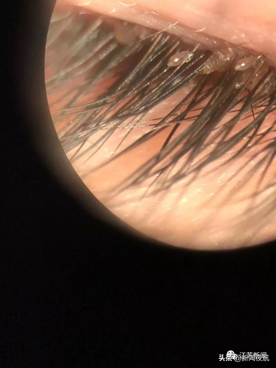 5岁女孩眼睛里取出20多只虱子，还在动！孩子总有这个动作，家长一定要重视