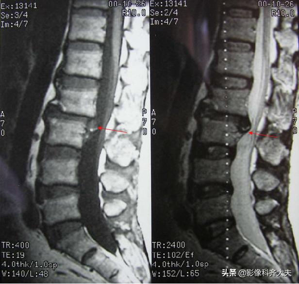 腰椎间盘突出的影像学诊断及治疗,腰椎间盘突出影像学课件