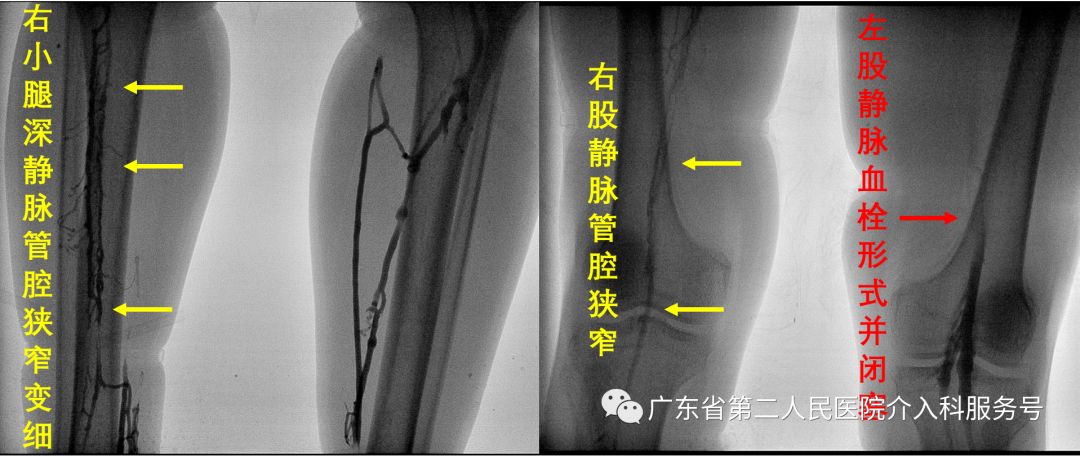 左腿血栓肿胀能完全恢复正常吗,左腿血栓肿痛怎么锻炼