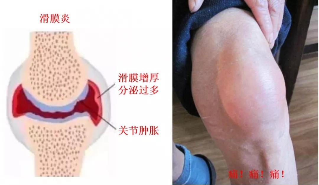 跑步最常见的十种伤痛及处理方法,跑步相关运动损伤综述