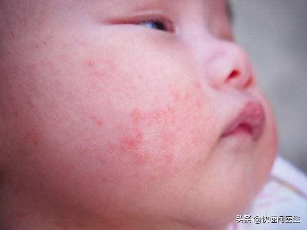 湿疹用的激素类药品,宝宝湿疹能用激素类药品吗