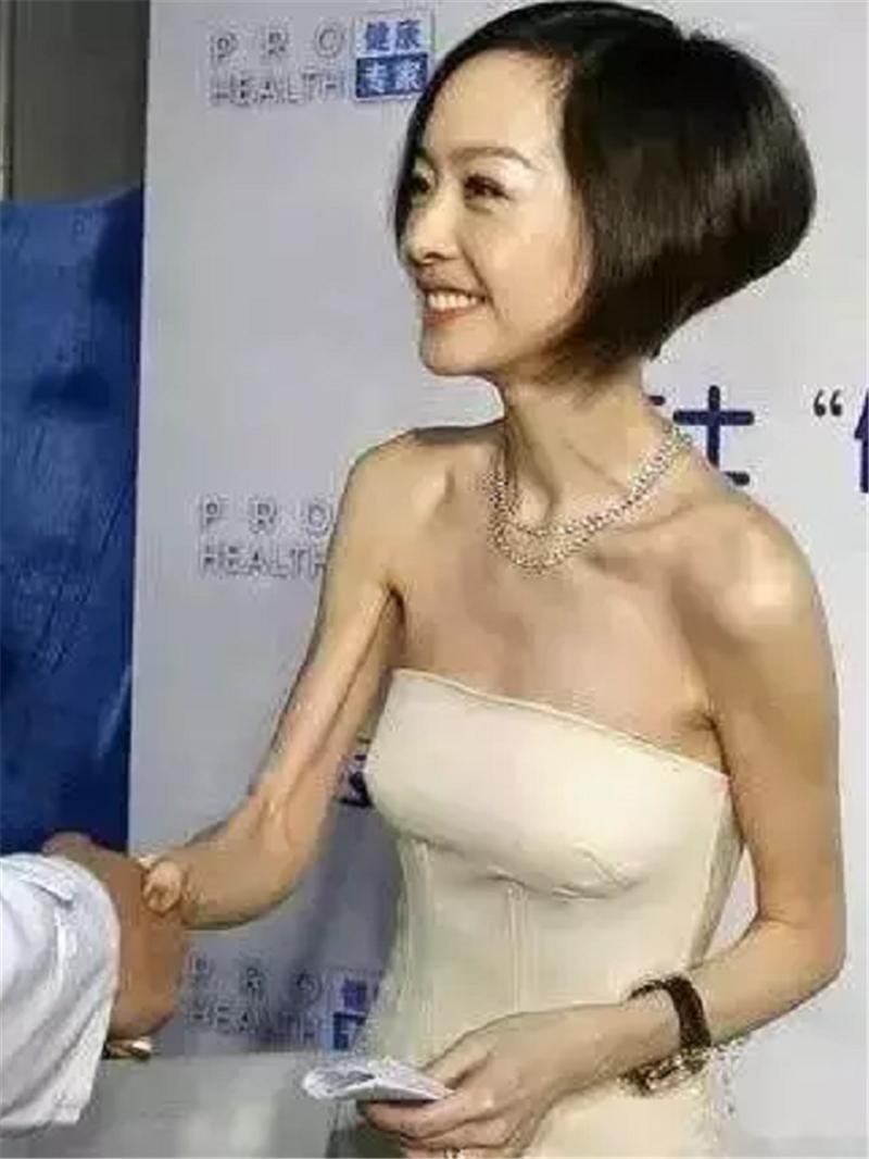 颧骨高导致脸型难看怎么办,脸型偏瘦颧骨明显怎么办改善