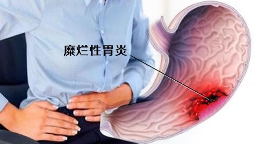 胃糜烂吃药一直不好,胃里有糜烂是怎么回事