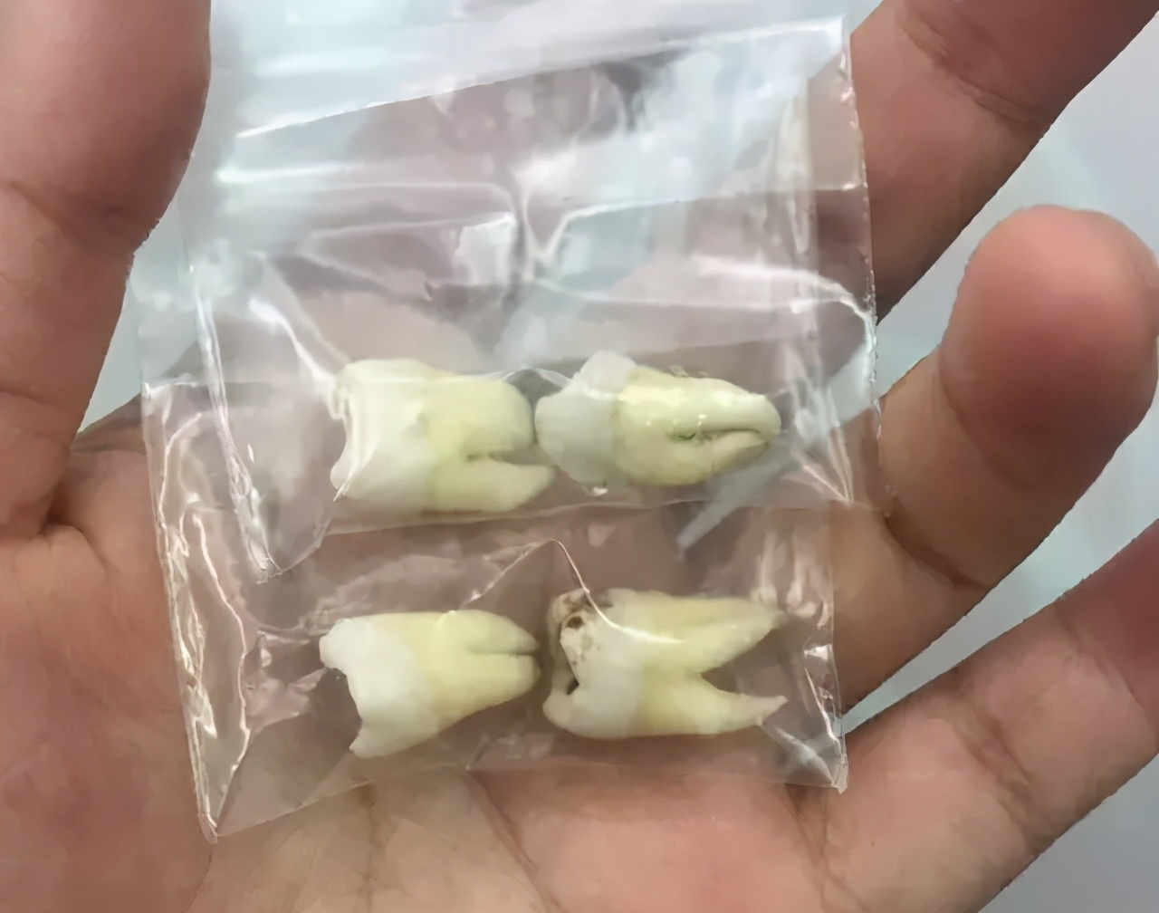 拔牙肿了没有知觉,拔牙后第三天脸肿冰敷还是热敷