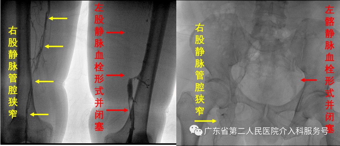 左腿血栓肿胀能完全恢复正常吗,左腿血栓肿痛怎么锻炼