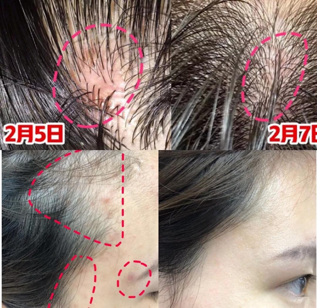 头油头屑痒洗发水,头油头皮屑多脱发洗发水