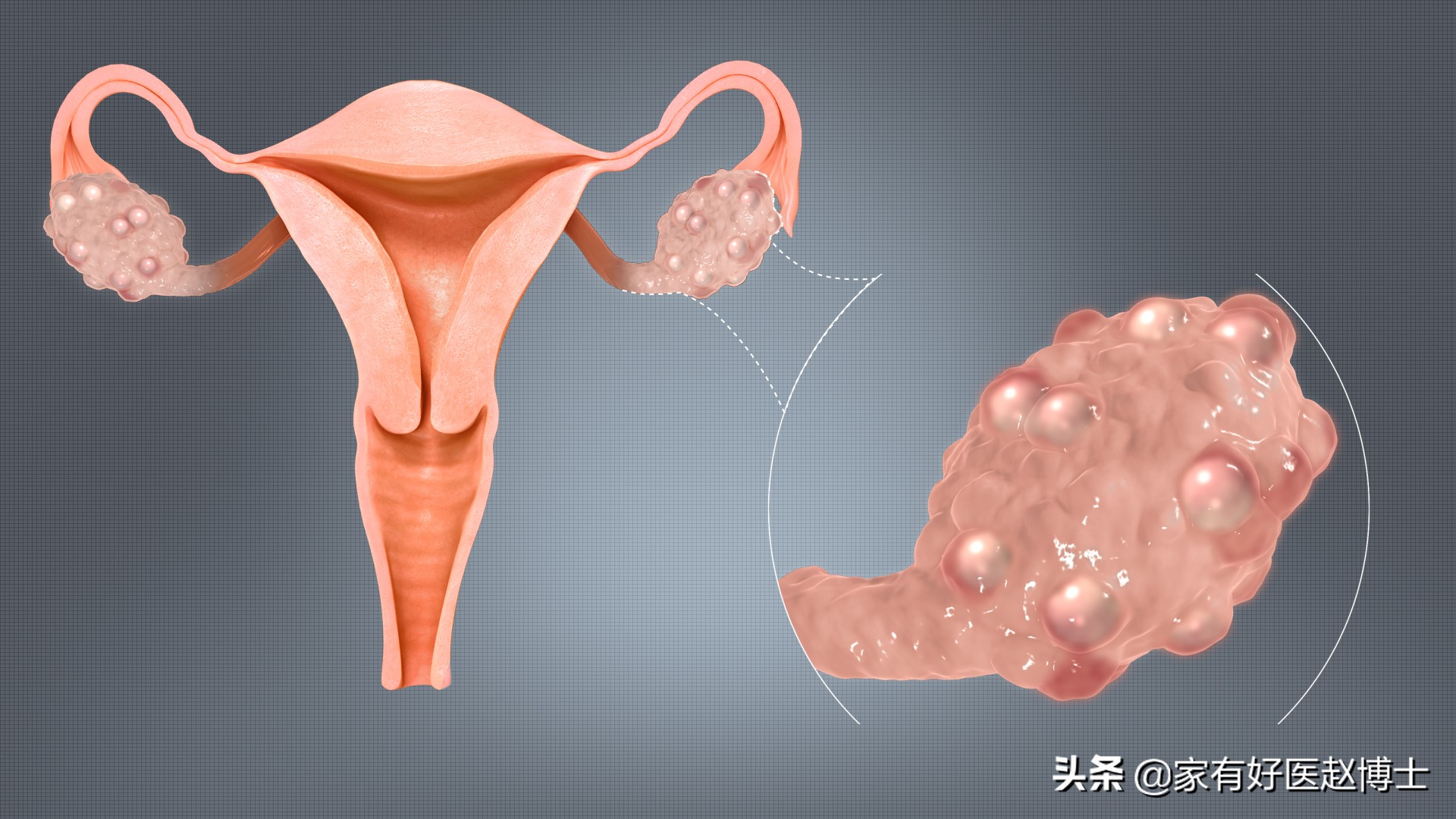 多囊卵巢综合征，为何减重是关键？一次说清：饮食、运动与药品