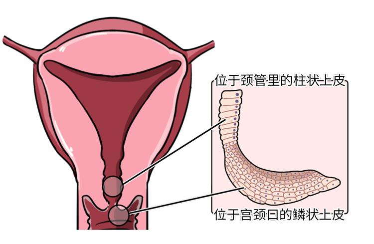 因为炎症宫颈糜烂需要治吗,宫颈糜烂引发夫妻感情破裂