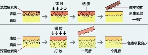 做完m22光子嫩肤反黑,做完光子嫩肤斑会反黑吗