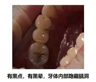 牙齿正面有小黑点千万不要忽视,不要小看牙齿的小黑点