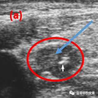 甲状腺癌术后8个月复发能活多久,甲状腺癌术后复发做131有用吗
