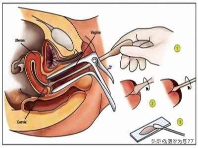 女性做宫颈癌筛查需要多少钱,65后需要做宫颈癌筛查吗