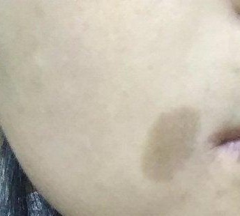 脸上的斑分为几种类型,脸上常见的6种斑