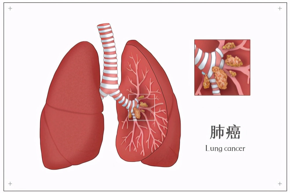 对于抗癌“*器武**”，中大肿瘤医院主任这样说