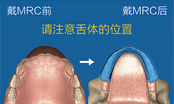 mrc矫正器小孩子晚上不愿意咬,mrc儿童牙齿矫正