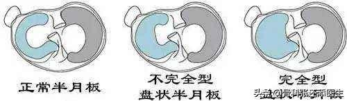 膝盖弯曲总是响是怎么回事,走路膝盖咯咯响有什么治疗方法