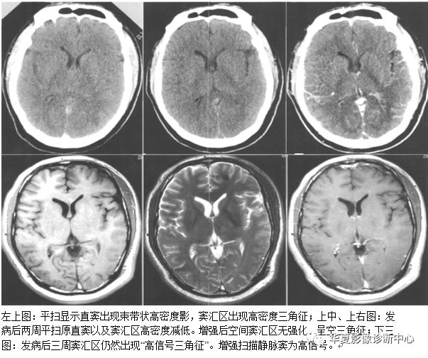 颅脑核磁影像解剖图谱,颅脑mr增强影像图片