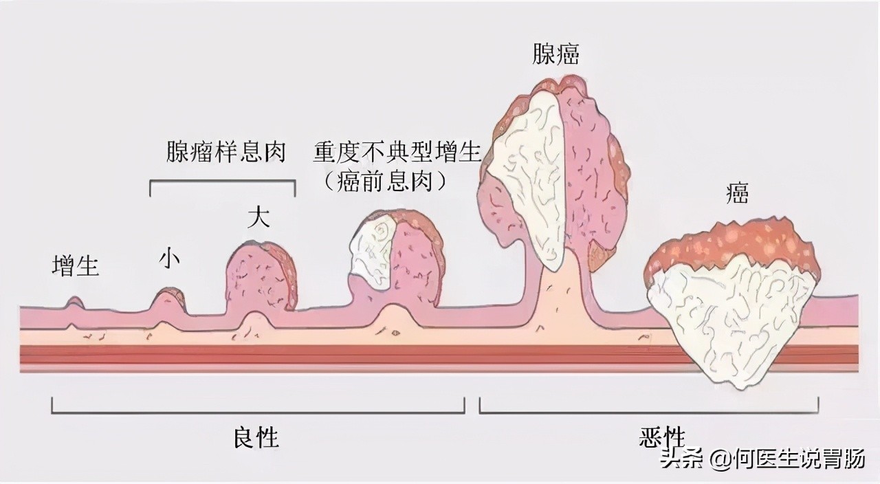 越来越多人因肠癌丧命,肛肠癌怎样缓解痛苦