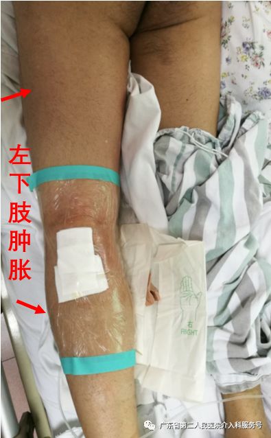 左腿血栓肿胀能完全恢复正常吗,左腿血栓肿痛怎么锻炼