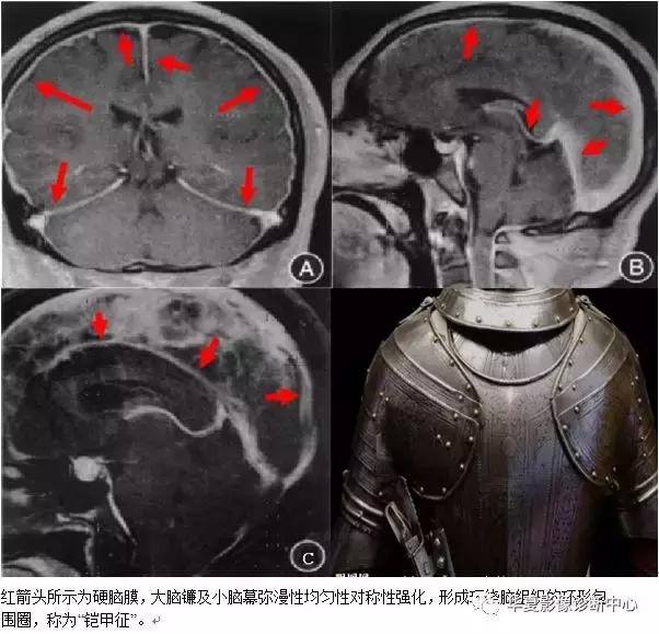 颅脑核磁影像解剖图谱,颅脑mr增强影像图片