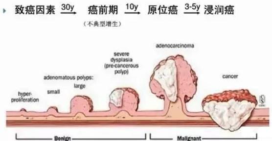 痔疮久了会变成直肠癌吗,痔疮为什么会变直肠癌