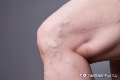 下肢静脉曲张外观不好看怎么办,下肢静脉曲张很难看怎么办