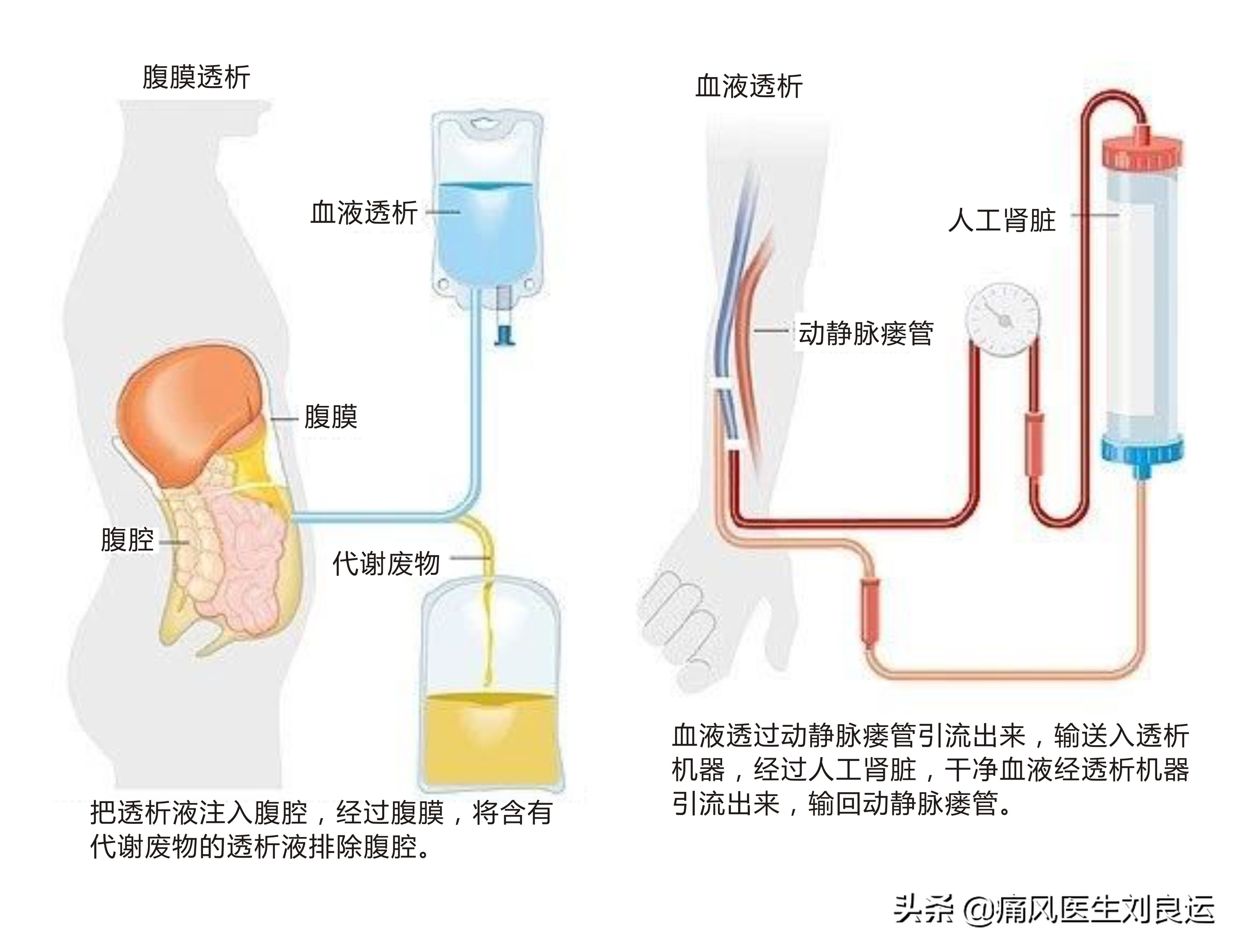 痛风不再痛一招降尿酸,痛风症状缓解后开始降尿酸治疗