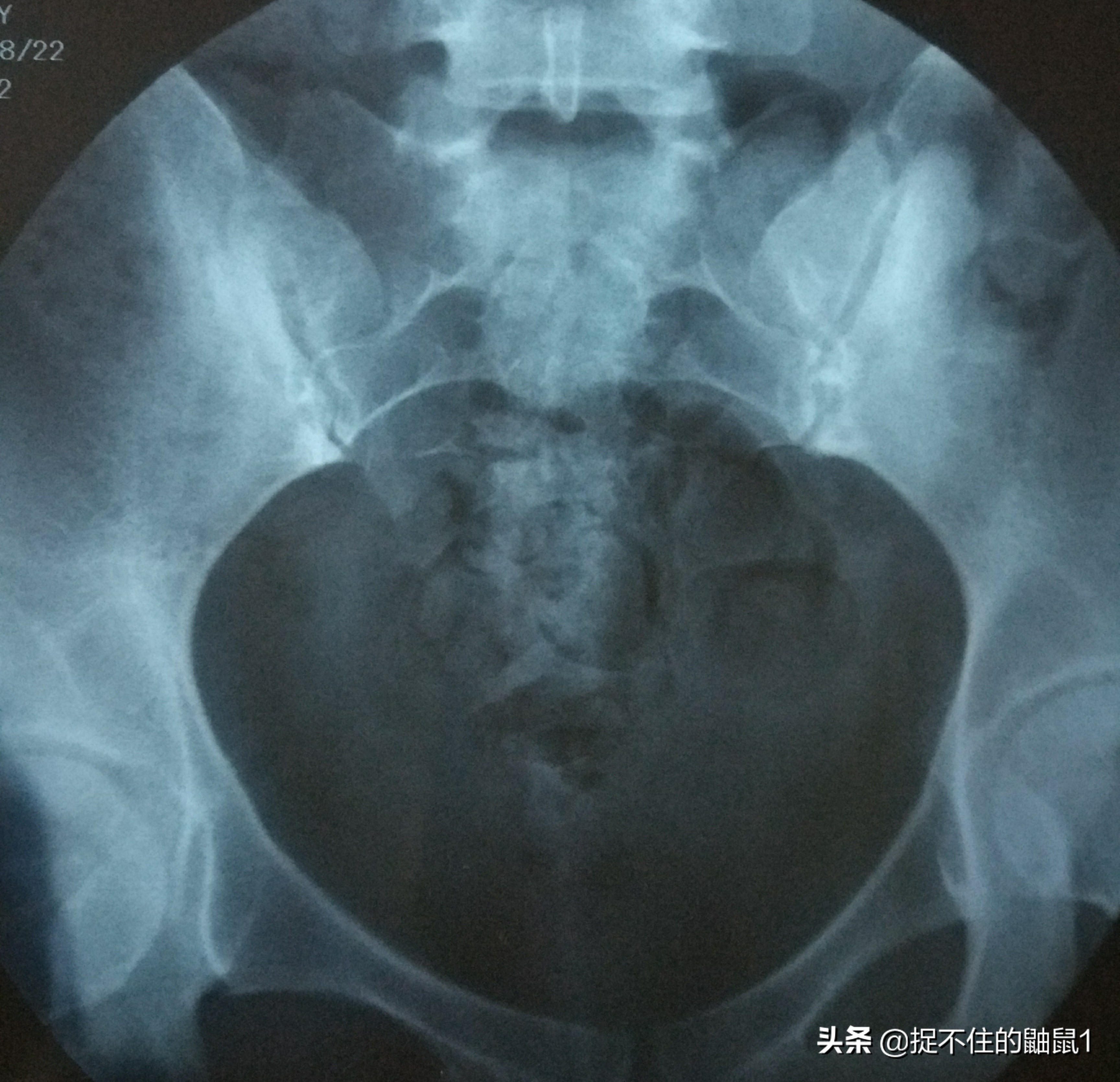 我的试管婴儿之路完整版,备孕十年试管之路