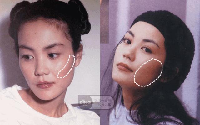 颧骨很凸太阳穴凹陷怎么改善,太阳穴凹陷颧骨突出怎么改善饱满