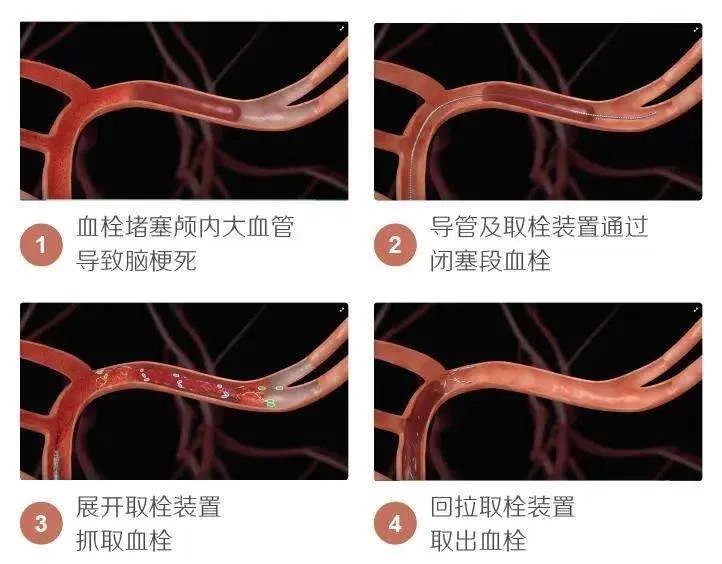 治疗脑梗死输什么液体最好,亚急性脑梗死怎么治疗最好