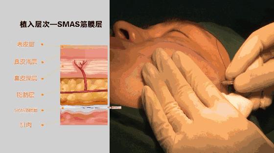 6d线雕提拉童颜术,不打针不开刀祛皱纹的轻医美