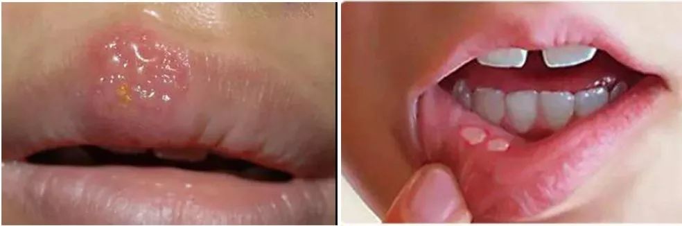 干裂救星护手霜,唇干裂用什么润唇好