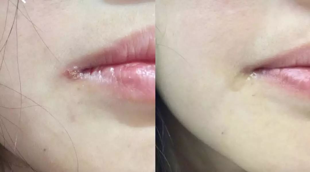 干裂救星护手霜,唇干裂用什么润唇好