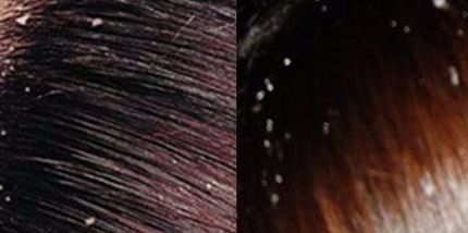 头上头皮屑和剪发虫怎么解决,头皮屑多和肚子里有虫有关系吗