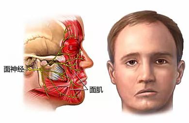 面瘫眉毛怎么恢复得快,面瘫后眉毛一高一低会正常吗