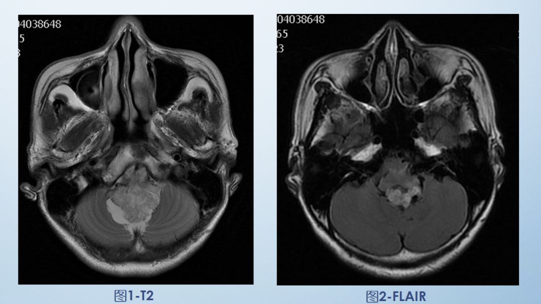 影像病例领会（3）：后颅窝实性占位病变