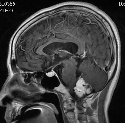 影像病例领会（3）：后颅窝实性占位病变