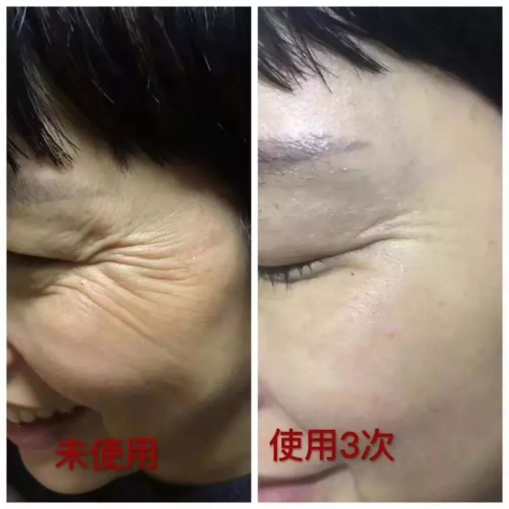 6d线雕提拉童颜术,不打针不开刀祛皱纹的轻医美