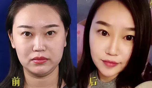 6d线雕提拉童颜术,不打针不开刀祛皱纹的轻医美