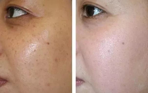 6d线雕提拉童颜术,不打针不开刀祛皱纹的轻医美